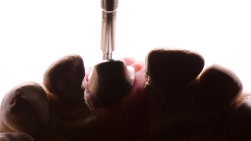 Prothese implantaire realisee par ISDL Lab