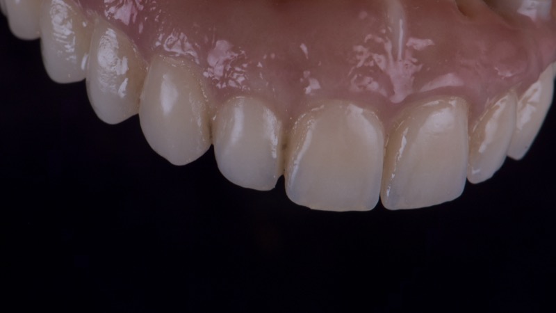 Facettes dentaires esthetiques realisees par ISDL Lab