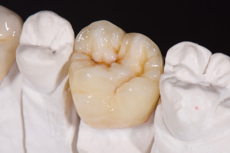 Restauration ceramique stratifiee realisee par ISDL Lab