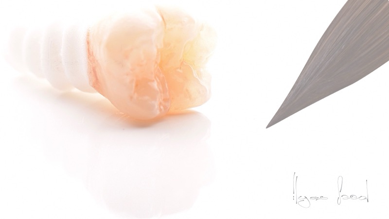 Couronne zircone realisee par ISDL Lab