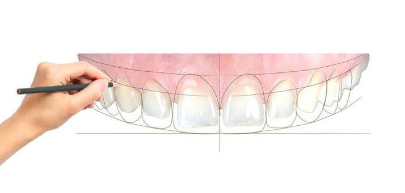 Conception numerique du sourire au laboratoire ISDL