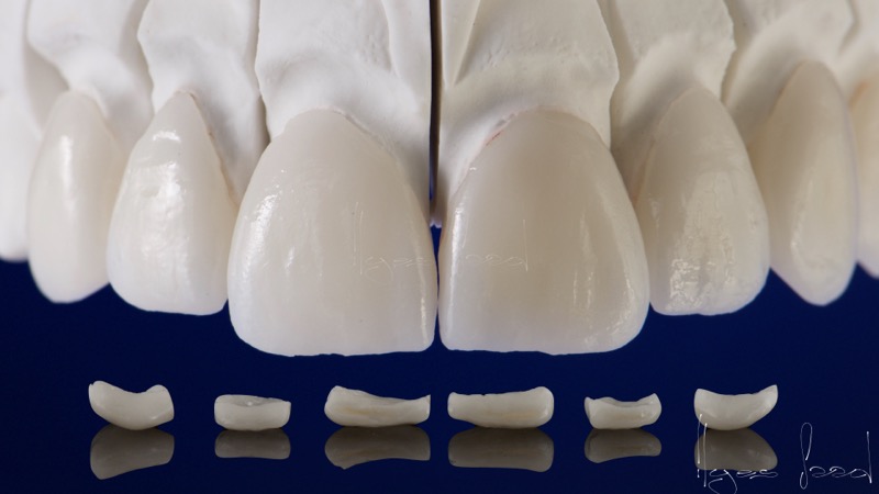 Facettes dentaires esthetiques realisees par ISDL Lab